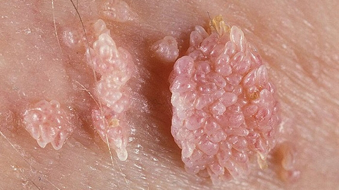 زگیل تناسلی HPV و راه های انتقال